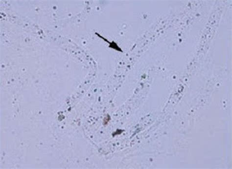mucus threads in tagalog|For urinalysis problem. Ko sa katawan. .